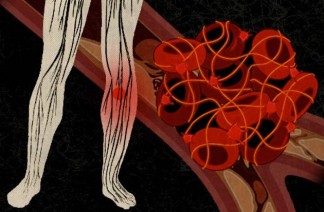 blood clots - kim carney